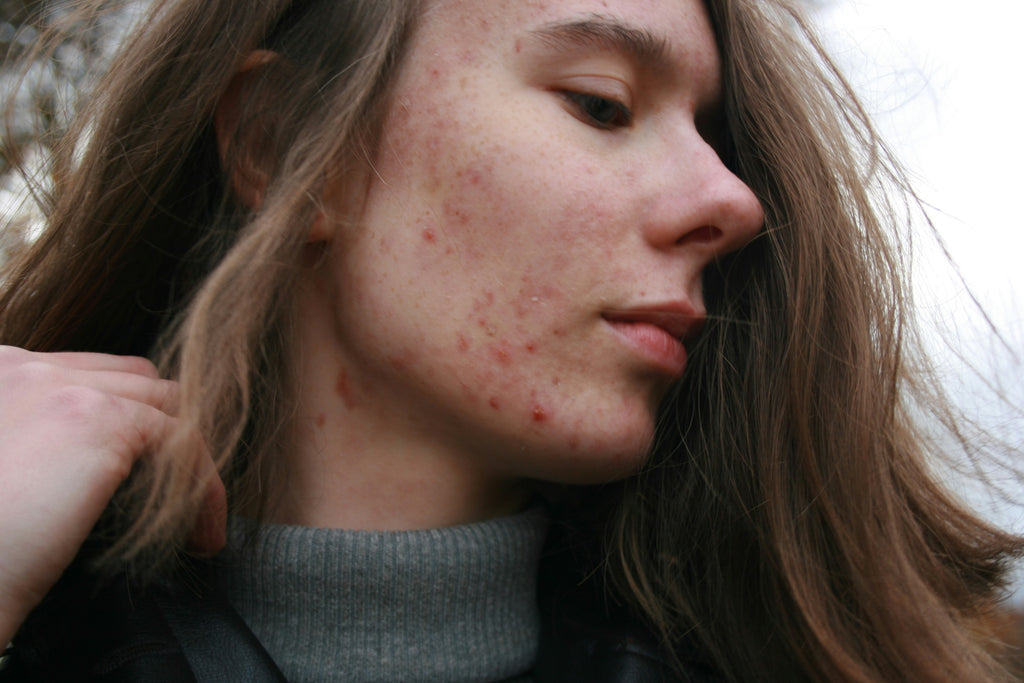 Acne Cure Fast: Your Guide to Clear Skin