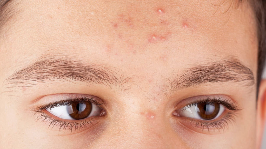 How to treat Acne ? Quick Guide : ACNE CURE FAST